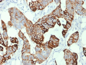 KRT20 / CK20 / Cytokeratin 20 Antibody - IHC testing of human colon carcinoma with CK20 antibody (clone KRT20/1993). Required HIER: boil tissue sections in 10mM citrate buffer, pH 6, for 10-20 min followed by cooling at RT for 20 min.