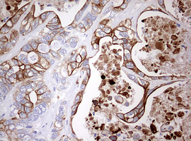 KRT20 / CK20 / Cytokeratin 20 Antibody - IHC of paraffin-embedded Adenocarcinoma of Human colon tissue using anti-KRT20 mouse monoclonal antibody. (Heat-induced epitope retrieval by 10mM citric buffer, pH6.0, 120°C for 3min).