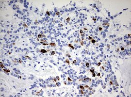 KRT20 / CK20 / Cytokeratin 20 Antibody - IHC of paraffin-embedded Carcinoma of Human pancreas tissue using anti-KRT20 mouse monoclonal antibody. (Heat-induced epitope retrieval by 10mM citric buffer, pH6.0, 120°C for 3min).