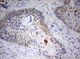 KRT20 / CK20 / Cytokeratin 20 Antibody - IHC of paraffin-embedded Carcinoma of Human lung tissue using anti-KRT20 mouse monoclonal antibody. (Heat-induced epitope retrieval by 10mM citric buffer, pH6.0, 120°C for 3min).