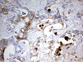 KRT20 / CK20 / Cytokeratin 20 Antibody - IHC of paraffin-embedded Adenocarcinoma of Human colon tissue using anti-KRT20 mouse monoclonal antibody. (Heat-induced epitope retrieval by 10mM citric buffer, pH6.0, 120°C for 3min).