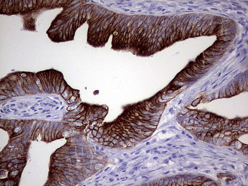 KRT20 / CK20 / Cytokeratin 20 Antibody - Immunohistochemical staining of paraffin-embedded Adenocarcinoma of Human colon tissue using anti-KRT20 mouse monoclonal antibody.  heat-induced epitope retrieval by 1 mM EDTA in 10mM Tris, pH8.5, 120C for 3min)