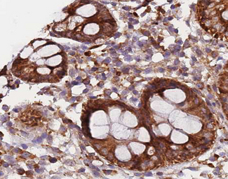 KRT20 / CK20 / Cytokeratin 20 Antibody - 1:200 staining human colon carcinoma tissue by IHC-P. The tissue was formaldehyde fixed and a heat mediated antigen retrieval step in citrate buffer was performed. The tissue was then blocked and incubated with the antibody for 1.5 hours at 22°C. An HRP conjugated goat anti-rabbit antibody was used as the secondary.