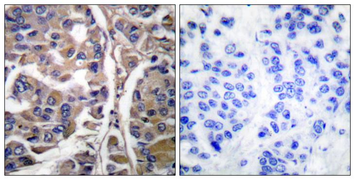 KRT20 / CK20 / Cytokeratin 20 Antibody - Peptide - + Immunohistochemical analysis of paraffin-embedded human breast carcinoma tissue using Keratin 20 antibody.