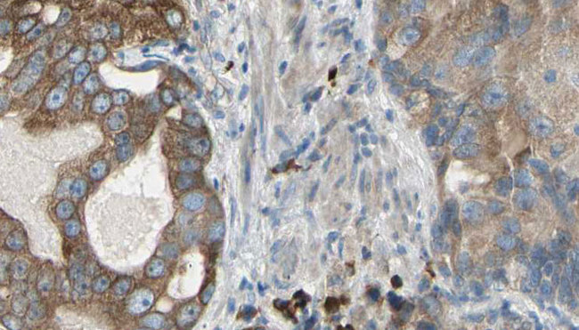 KRT23 / Keratin 23 Antibody - 1:100 staining human prostate tissue by IHC-P. The sample was formaldehyde fixed and a heat mediated antigen retrieval step in citrate buffer was performed. The sample was then blocked and incubated with the antibody for 1.5 hours at 22°C. An HRP conjugated goat anti-rabbit antibody was used as the secondary.