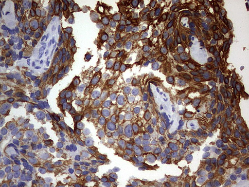 KRT24 / Keratin 24 Antibody - IHC of paraffin-embedded Adenocarcinoma of Human breast tissue using anti-KRT24 mouse monoclonal antibody. (Heat-induced epitope retrieval by 1 mM EDTA in 10mM Tris, pH9.0, 120°C for 3min).