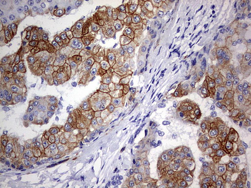 KRT24 / Keratin 24 Antibody - IHC of paraffin-embedded Carcinoma of Human liver tissue using anti-KRT24 mouse monoclonal antibody. (Heat-induced epitope retrieval by 1 mM EDTA in 10mM Tris, pH9.0, 120°C for 3min).