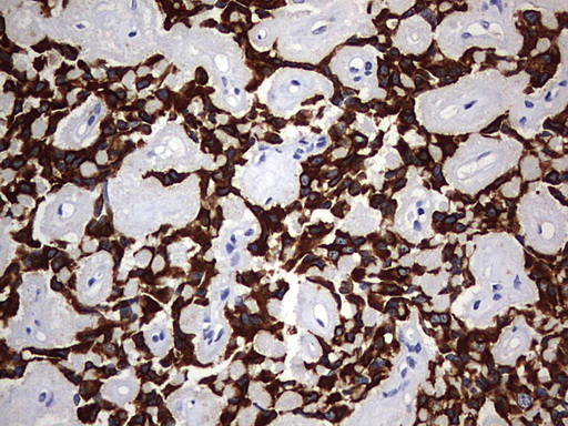 KRT24 / Keratin 24 Antibody - IHC of paraffin-embedded Carcinoma of Human pancreas tissue using anti-KRT24 mouse monoclonal antibody. (Heat-induced epitope retrieval by 1 mM EDTA in 10mM Tris, pH9.0, 120°C for 3min).