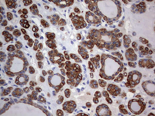 KRT24 / Keratin 24 Antibody - IHC of paraffin-embedded Carcinoma of Human thyroid tissue using anti-KRT24 mouse monoclonal antibody. (Heat-induced epitope retrieval by 1 mM EDTA in 10mM Tris, pH9.0, 120°C for 3min).
