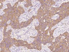 KRT24 / Keratin 24 Antibody - Immunochemical staining of human KRT24 in human breast carcinoma with rabbit polyclonal antibody at 1:2000 dilution, formalin-fixed paraffin embedded sections.