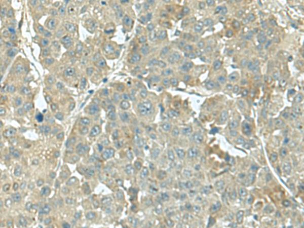 KRT36 / Keratin 36 / KRTHA6 Antibody - Immunohistochemistry of paraffin-embedded Human liver cancer tissue  using KRT36 Polyclonal Antibody at dilution of 1:55(×200)