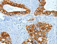 KRT40 / Hair Keratin KA36 Antibody - Immunohistochemistry of paraffin-embedded Human cervical cancer using KRT40 Polyclonal Antibody at dilution of 1:50.