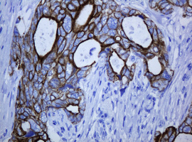 KRT5 / CK5 / Cytokeratin 5 Antibody - IHC of paraffin-embedded Adenocarcinoma of Human breast tissue using anti-KRT5 mouse monoclonal antibody.