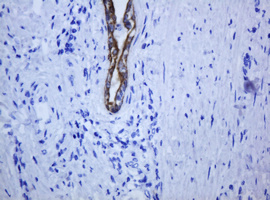 KRT5 / CK5 / Cytokeratin 5 Antibody - IHC of paraffin-embedded Carcinoma of Human prostate tissue using anti-KRT5 mouse monoclonal antibody.