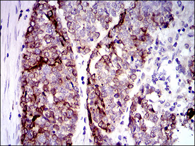 KRT5 / CK5 / Cytokeratin 5 Antibody - IHC of paraffin-embedded esophageal cancer tissues using CK5 mouse monoclonal antibody with DAB staining.