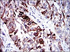 KRT5 / CK5 / Cytokeratin 5 Antibody - IHC of paraffin-embedded bladder cancer tissues using CK5 mouse monoclonal antibody with DAB staining.
