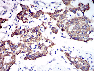 KRT5 / CK5 / Cytokeratin 5 Antibody - IHC of paraffin-embedded esophagus cancer tissues using CK5 mouse monoclonal antibody with DAB staining.