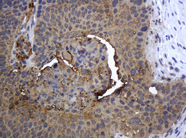 KRT5 / CK5 / Cytokeratin 5 Antibody - IHC of paraffin-embedded Carcinoma of Human lung tissue using anti-KRT5 mouse monoclonal antibody.