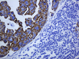 KRT5 / CK5 / Cytokeratin 5 Antibody - IHC of paraffin-embedded Carcinoma of Human bladder tissue using anti-KRT5 mouse monoclonal antibody.