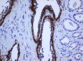 KRT5 / CK5 / Cytokeratin 5 Antibody - IHC of paraffin-embedded Carcinoma of Human prostate tissue using anti-KRT5 mouse monoclonal antibody.
