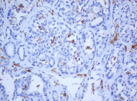 KRT5 / CK5 / Cytokeratin 5 Antibody - IHC of paraffin-embedded Carcinoma of Human thyroid tissue using anti-KRT5 mouse monoclonal antibody.