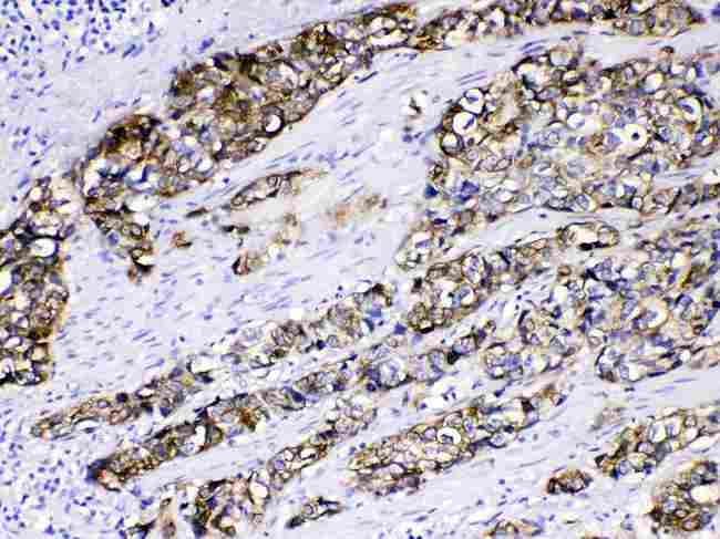 KRT5 / CK5 / Cytokeratin 5 Antibody - Cytokeratin 5 was detected in paraffin-embedded sections of human oesophagus squama cancer tissues using rabbit anti- Cytokeratin 5 Antigen Affinity purified polyclonal antibody