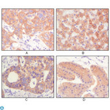 KRT5 / CK5 / Cytokeratin 5 Antibody - Immunohistochemistry (IHC) analysis of paraffin-embedded Human Lung squamous cell carcinoma (A), normal hepatocyte (B), colon adenocacinoma (C), normal stomach tissue (D), showing cytoplasmic and membrane localization with DAB staining using Cytokeratin (Pan) M.