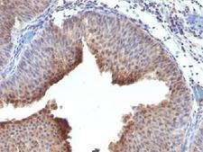 KRT6 / CK6 / Cytokeratin 6 Antibody - IHC testing of FFPE human bladder carcinoma and Cytokeratin 6 antibody. This image was taken for the unmodified form of this product. Other forms have not been tested.