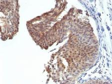 KRT6 / CK6 / Cytokeratin 6 Antibody - IHC testing of FFPE human bladder carcinoma with Cytokeratin 6 antibody (clone KRT6/1702). Required HIER: boil tissue sections in 10mM citrate buffer, pH 6, for 10-20 min.