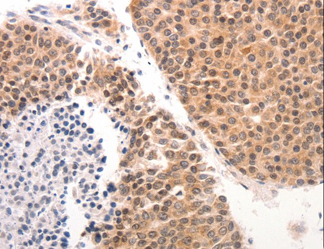 KRT6 / CK6 / Cytokeratin 6 Antibody - Immunohistochemistry of paraffin-embedded Human ovarian cancer using KRT6A/KRT6B/KRT6C Polyclonal Antibody at dilution of 1:50.