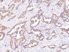 KRT6C / CK6C / Cytokeratin 6C Antibody - Immunochemical staining of human KRT6C in human breast carcinoma with rabbit polyclonal antibody at 1:300 dilution, formalin-fixed paraffin embedded sections.