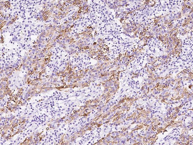 KRT6C / CK6C / Cytokeratin 6C Antibody - Immunochemical staining of human KRT6C in human lung cancer with rabbit polyclonal antibody at 1:300 dilution, formalin-fixed paraffin embedded sections.
