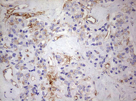 KRT7 / CK7 / Cytokeratin 7 Antibody - IHC of paraffin-embedded Carcinoma of Human pancreas tissue using anti-KRT7 mouse monoclonal antibody. (Heat-induced epitope retrieval by 10mM citric buffer, pH6.0, 120°C for 3min).