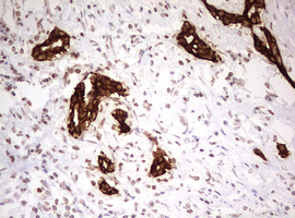 KRT7 / CK7 / Cytokeratin 7 Antibody - IHC of paraffin-embedded Carcinoma of Human liver tissue using anti-KRT7 mouse monoclonal antibody. (Heat-induced epitope retrieval by 10mM citric buffer, pH6.0, 120°C for 3min).