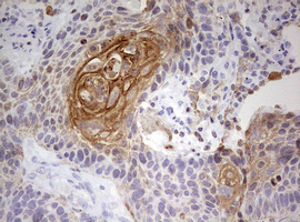 KRT7 / CK7 / Cytokeratin 7 Antibody - IHC of paraffin-embedded Carcinoma of Human lung tissue using anti-KRT7 mouse monoclonal antibody. (Heat-induced epitope retrieval by 10mM citric buffer, pH6.0, 120°C for 3min).