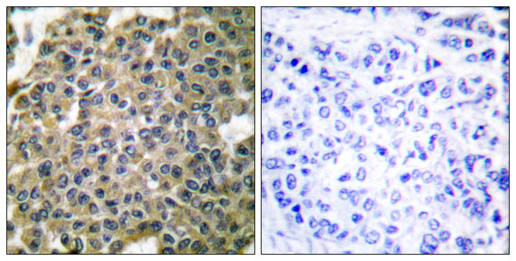 KRT7 / CK7 / Cytokeratin 7 Antibody - Immunohistochemistry analysis of paraffin-embedded human breast carcinoma tissue, using Keratin 7 Antibody. The picture on the right is blocked with the synthesized peptide.
