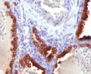 KRT7 / CK7 / Cytokeratin 7 Antibody - IHC testing of FFPE human lung carcinoma and Cytokeratin 7 antibody (clone CTKN7-1 ).  This image was taken for the unmodified form of this product. Other forms have not been tested.