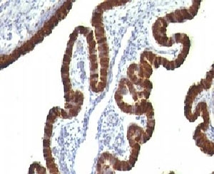 KRT7 / CK7 / Cytokeratin 7 Antibody - IHC testing of human ovarian carcinoma and Cytokeratin 7 antibody (clone CTKN7-1).  This image was taken for the unmodified form of this product. Other forms have not been tested.