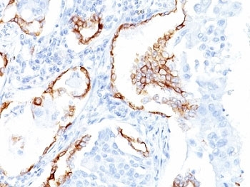 KRT7 / CK7 / Cytokeratin 7 Antibody - Formalin-fixed, paraffin-embedded human lung SCC stained with Keratin 7 antibody (K72.7).  This image was taken for the unmodified form of this product. Other forms have not been tested.