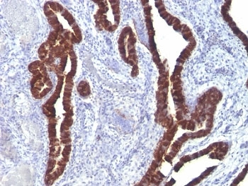 KRT7 / CK7 / Cytokeratin 7 Antibody - Formalin-fixed, paraffin-embedded ovarian carcinoma stained with Keratin 7 antibody (K72.7).  This image was taken for the unmodified form of this product. Other forms have not been tested.