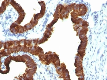 KRT7 / CK7 / Cytokeratin 7 Antibody - Formalin-fixed, paraffin-embedded human ovarian carcinoma stained with Keratin 7 antibody (KRT7/1198).  This image was taken for the unmodified form of this product. Other forms have not been tested.