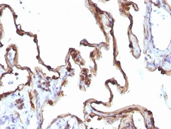 KRT7 / CK7 / Cytokeratin 7 Antibody - Formalin-fixed, paraffin-embedded human lung carcinoma stained with Keratin 7 antibody (KRT7/1198).  This image was taken for the unmodified form of this product. Other forms have not been tested.