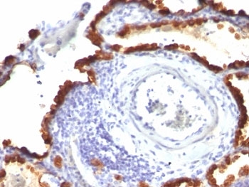 KRT7 / CK7 / Cytokeratin 7 Antibody - Formalin-fixed, paraffin-embedded human lung carcinoma stained with Keratin 7 antibody (KRT7/760 + KRT7/903).  This image was taken for the unmodified form of this product. Other forms have not been tested.