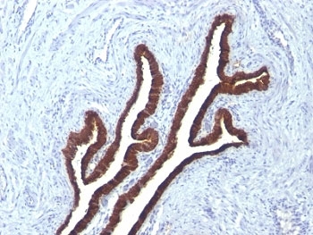 KRT7 / CK7 / Cytokeratin 7 Antibody - Formalin-fixed, paraffin-embedded human ovarian carcinoma stained with Keratin 7 antibody (KRT7/760 + KRT7/903).  This image was taken for the unmodified form of this product. Other forms have not been tested.
