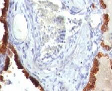 KRT7 / CK7 / Cytokeratin 7 Antibody - Formalin-fixed, paraffin-embedded human lung carcinoma stained with Cytokeratin 7 antibody (KRT7/760).  This image was taken for the unmodified form of this product. Other forms have not been tested.