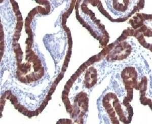 KRT7 / CK7 / Cytokeratin 7 Antibody - Formalin-fixed, paraffin-embedded human ovarian carcinoma stained with Cytokeratin 7 antibody (KRT7/760).  This image was taken for the unmodified form of this product. Other forms have not been tested.