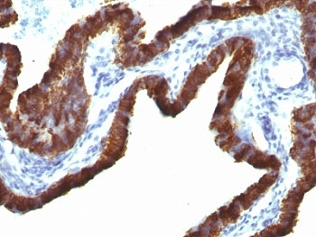KRT7 / CK7 / Cytokeratin 7 Antibody - Formalin-fixed, paraffin-embedded human ovarian carcinoma stained with Cytokeratin 7 antibody (KRT7/760 + OV-TL12/30).  This image was taken for the unmodified form of this product. Other forms have not been tested.