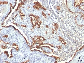 KRT7 / CK7 / Cytokeratin 7 Antibody - Formalin-fixed, paraffin-embedded human lung carcinoma stained with Cytokeratin 7 antibody (KRT7/760 + OV-TL12/30).  This image was taken for the unmodified form of this product. Other forms have not been tested.