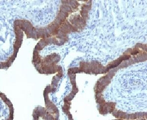 KRT7 / CK7 / Cytokeratin 7 Antibody - Formalin-fixed, paraffin-embedded human ovarian carcinoma stained with Cytokeratin 7 antibody (KRT7/903).  This image was taken for the unmodified form of this product. Other forms have not been tested.