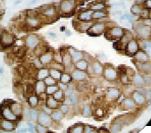 KRT7 / CK7 / Cytokeratin 7 Antibody - IHC of CK 7 on FFPE Lung Adenocarcinoma tissue. This image was taken for the unmodified form of this product. Other forms have not been tested.